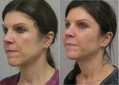 Cheek Augmentation before and after photo