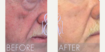 Cheek Augmentation before and after photo