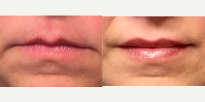 Dermal Fillers before and after photo