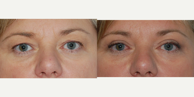 Eyelid Surgery before and after photo