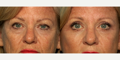 Eyelid Surgery before and after photo