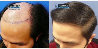 FUE Hair Transplant before and after photo