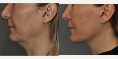 Rhinoplasty before and after photo