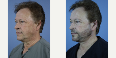 Eyelid Surgery before and after photo