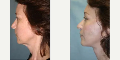 Facelift before and after photo