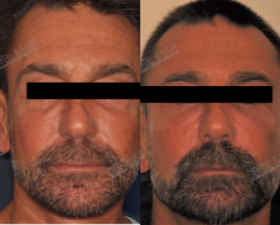 Liquid Facelift before and after photo