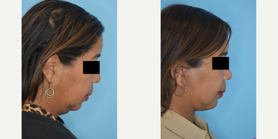 Chin Liposuction before and after photo