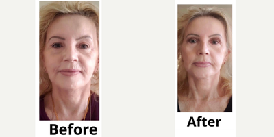Eyelid Surgery before and after photo