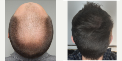 Hair Transplant before and after photo