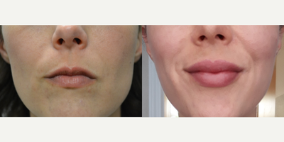 Restylane Silk before and after photo