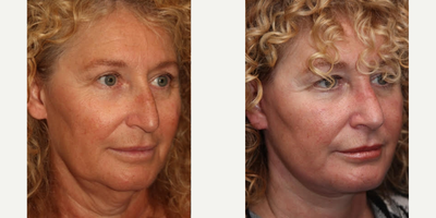 Deep Plane Facelift before and after photo