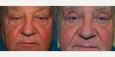 Eyelid Surgery before and after photo
