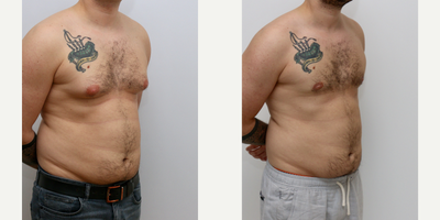Gynecomastia Surgery before and after photo