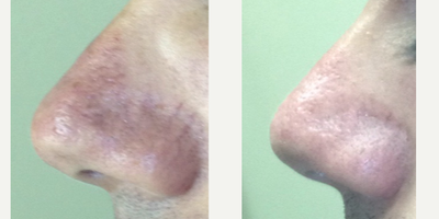 Laser Resurfacing before and after photo