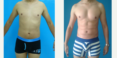 Liposculpture before and after photo