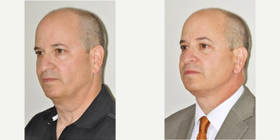 Neck Lift before and after photo
