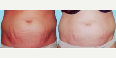CO2 Laser before and after photo