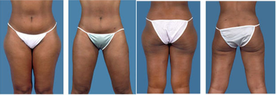 Liposuction before and after photo
