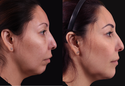 Chin Filler before and after photo
