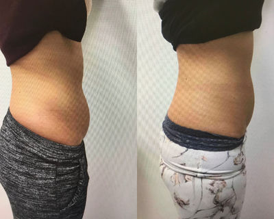 CoolSculpting before and after photo