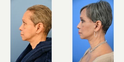 before and after image