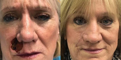Facial Reconstructive Surgery before and after photo