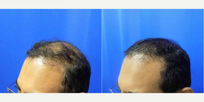 Hair Transplant before and after photo