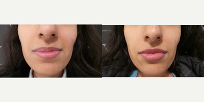 Lip Fillers before and after photo