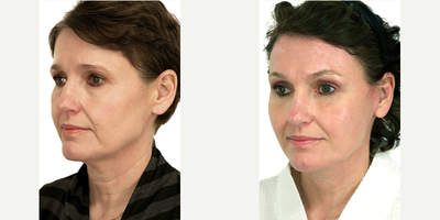 Neck Lift before and after photo