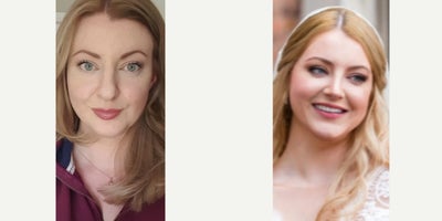 Rhinoplasty before and after photo