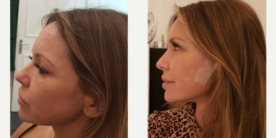 Silhouette Soft before and after photo