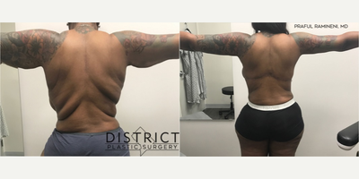 Back Lift before and after photo