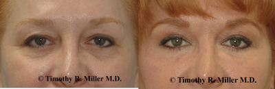 Eyelid Surgery before and after photo