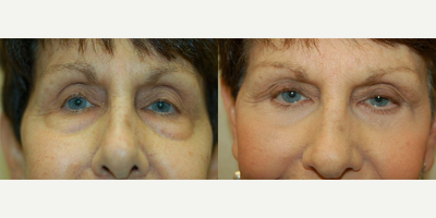 Eyelid Surgery before and after photo