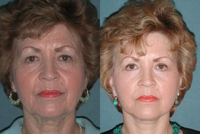 Facelift before and after photo