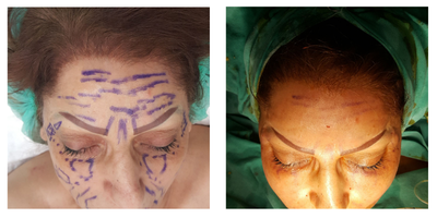 Facial Fat Transfer before and after photo