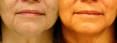 Juvederm before and after photo