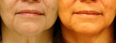 Juvederm before and after photo