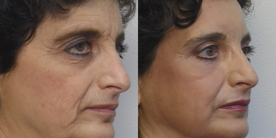 Laser Resurfacing before and after photo