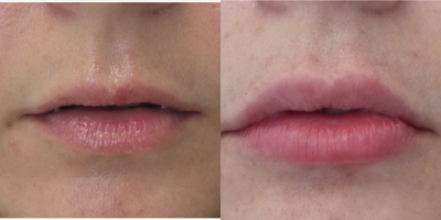 Lip Fillers before and after photo