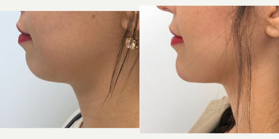 Restylane before and after photo