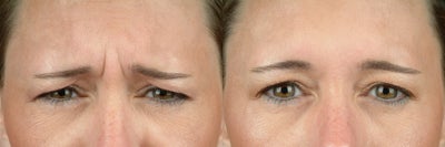 Botox before and after photo