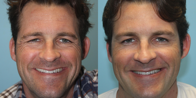 Botox before and after photo