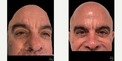Botox before and after photo
