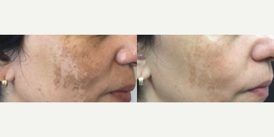 Chemical Peel before and after photo