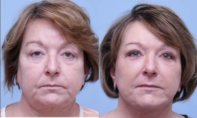 Facelift before and after photo