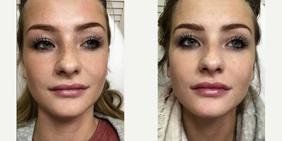 Lip Fillers before and after photo