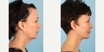 Neck Lift before and after photo