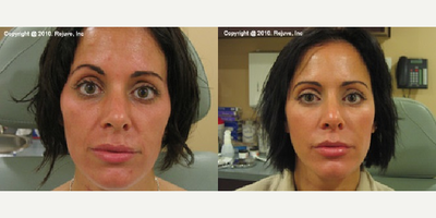 Radiesse before and after photo