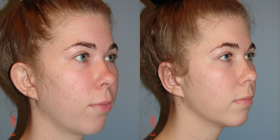Ear Surgery before and after photo